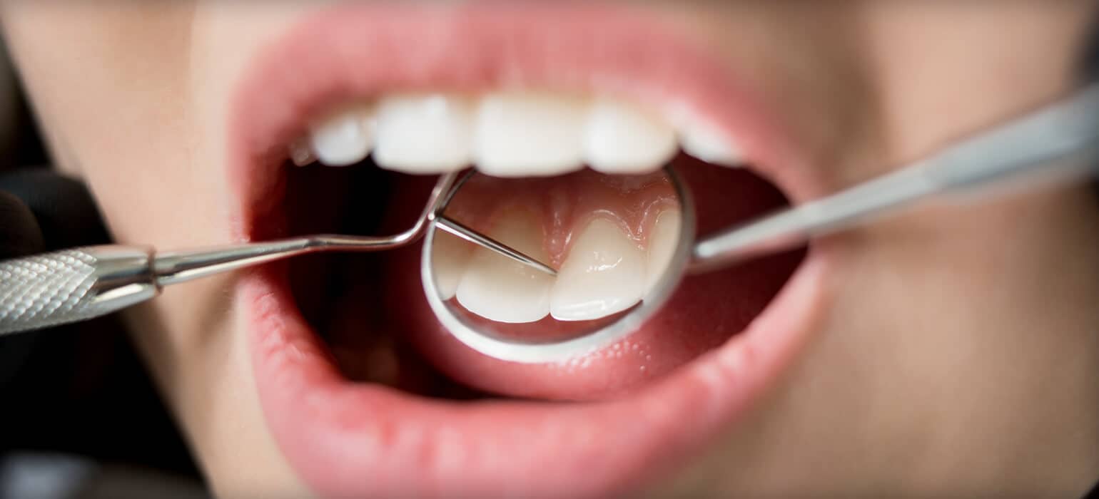 Gum Disease/Periodontal Disease - konikoff